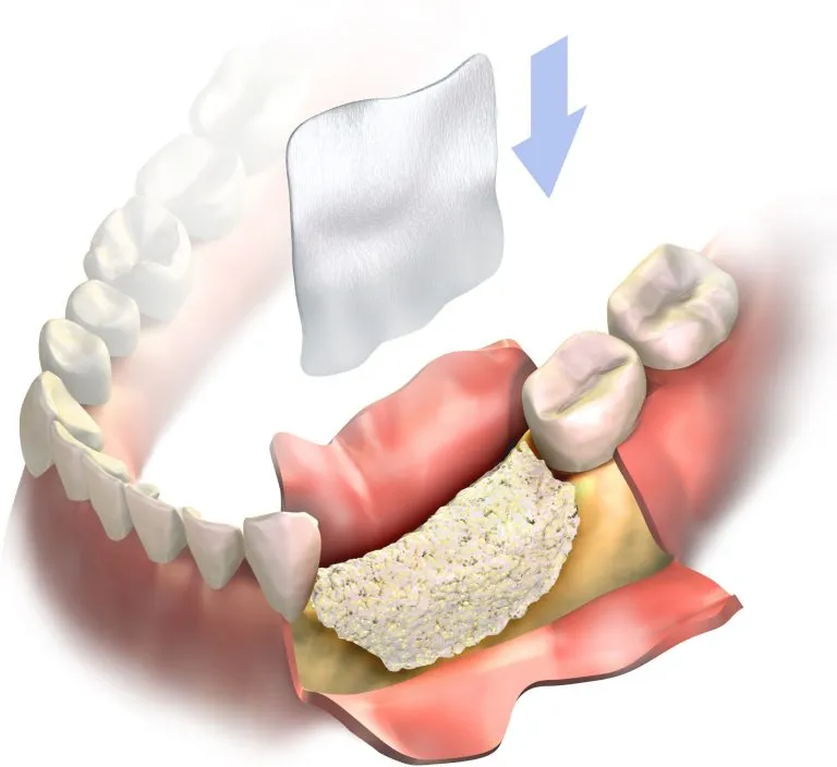 Bone Grafting San Jose & Hill Bone Graft for Dental Implants